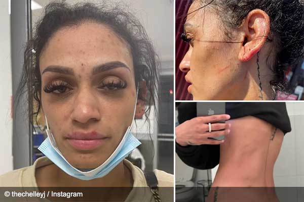 Mychelle Johnson posts photos of alleged domestic violence attack from Miles Bridges 